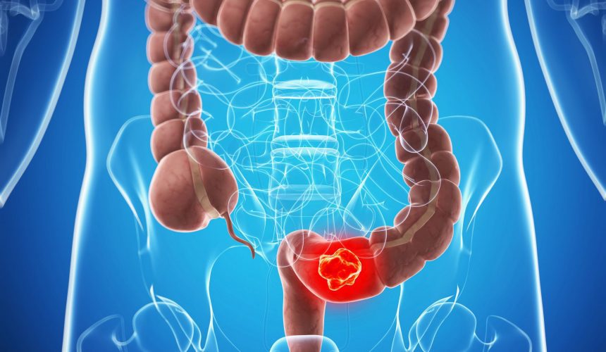 8 СИМПТОМОВ РАКА ТОЛСТОГО КИШЕЧНИКА, О КОТОРЫХ ВЫ ДОЛЖНЫ ЗНАТЬ